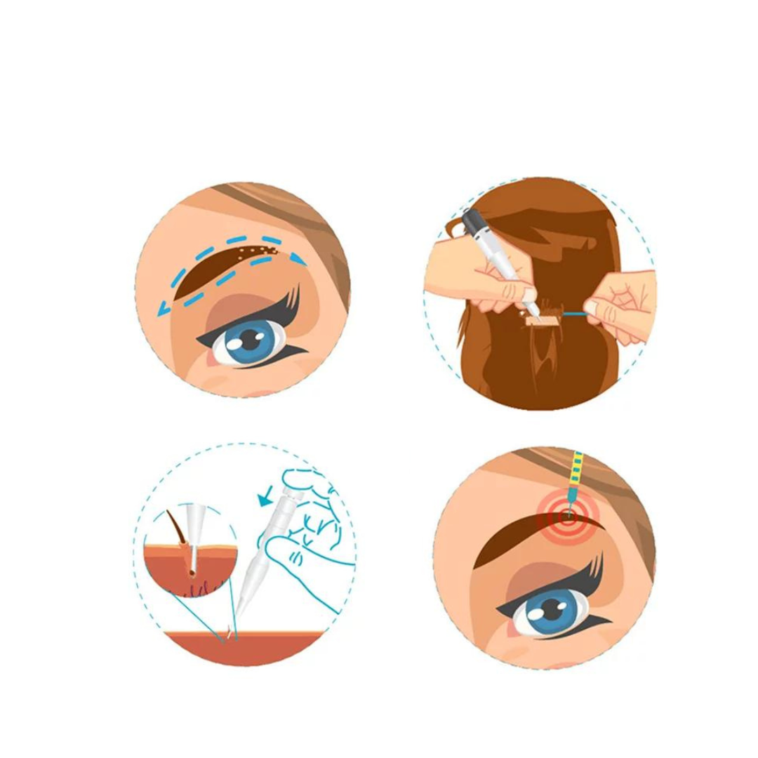 Eyebrow Transplantation